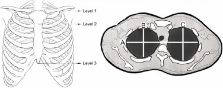 Measured thoracic levels and distances on axial CT images Measured thoracic levels and distances on axial CT images