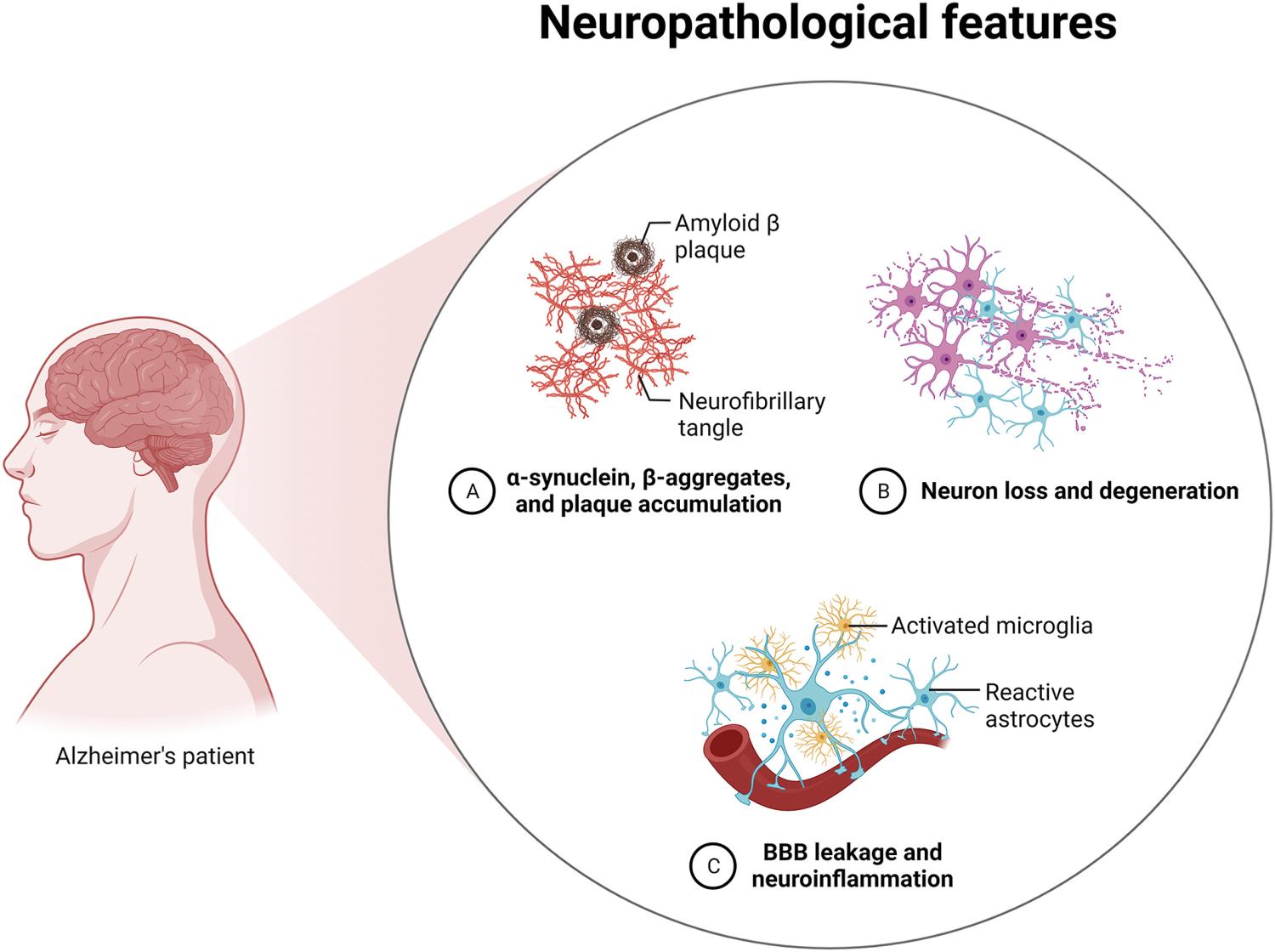 Fig. 1. Illustration representing Neuropathological features associated with Alzheimer's disease. Reprinted with Permission ( Soliman and Mohamed, 2023 ). Copyright Springer.