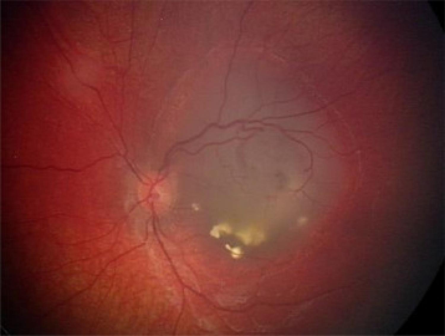 Colour fundus photography of an individual with a retinoma.